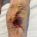 0500165 - Large skin tear - Photo #1