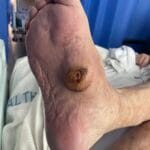 0515418 - diab ft #1