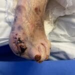 1064293 - Amputated toe (betadine) Photo #3