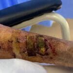 1110605 - Skin tears - Photo #6