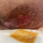 11110795 - PI on leg and sacrum - Photo #1