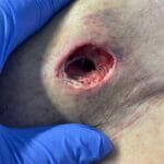 11633648 - infected graft - Photo3