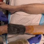 1191838 - Removing Vac dressing off a ssg - Feature picture