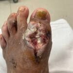 12237109 - Rheumatoid wound - Photo #5