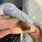 12311709 - Dry necrosis fingers - Photo #2