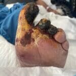 12311709 - Dry necrosis of toes - Photo #6