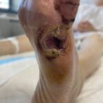 2273603 - Left foot toe amputation - Photo #1