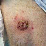 4090318 - cancer on leg - Photo #1