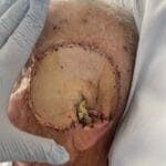 4509060 - Flap and donor site - Photo #3