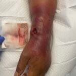 769432 - IVDU wounds - 1042024 Photo #1