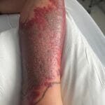 8665635 - cellulitis (no blisters) - picture #1