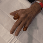 Amputated finger suture line - Picture #3