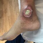 Ankle Ulcer - 1384759 - Photo 2