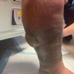 Blisters - cardiac - WTA - photo 1