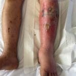 Cellulitis - 796828 - Photo 2