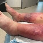 Cellulitis - pitting 1327390 - Photo 2