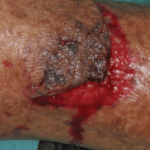 Skin tear - category 2a