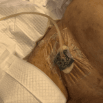 TWS - Vac - exudate management (infected femoral graft) - Picture #8