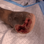 Vac - Forefoot With bridge dressing photos #1