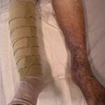 Vascularistis - with FarrowWraps - Feature picture