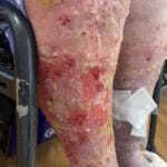 Venous Eczema - 0313940 - Photo 2